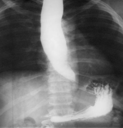 Bolla gastrica, Rx del transito esofago–gastro-duodenale per studio morfologico esofago - Acalasia esofagea