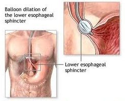 Dilatazione pneumatica esofago acalasico ed iniezione tossina botulinica - terapia endoscopica Acalasia - Copia