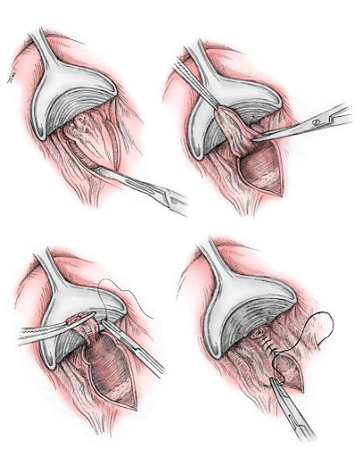 Emorroidectomia - asportazione chirurgica del tessuto emorroidario