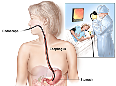 Esofago–gastro–duodenoscopia (EGDS) - Acalasia esofagea