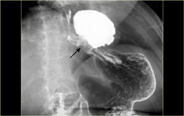 Rx del transito esofago–gastro-duodenale