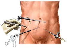 tecnica mininvasiva (laparoscopia)