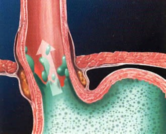 La MRGE rappersenta un aumentato di rischio di sviluppo di tumore maligno (carcinoma) dell’esofago