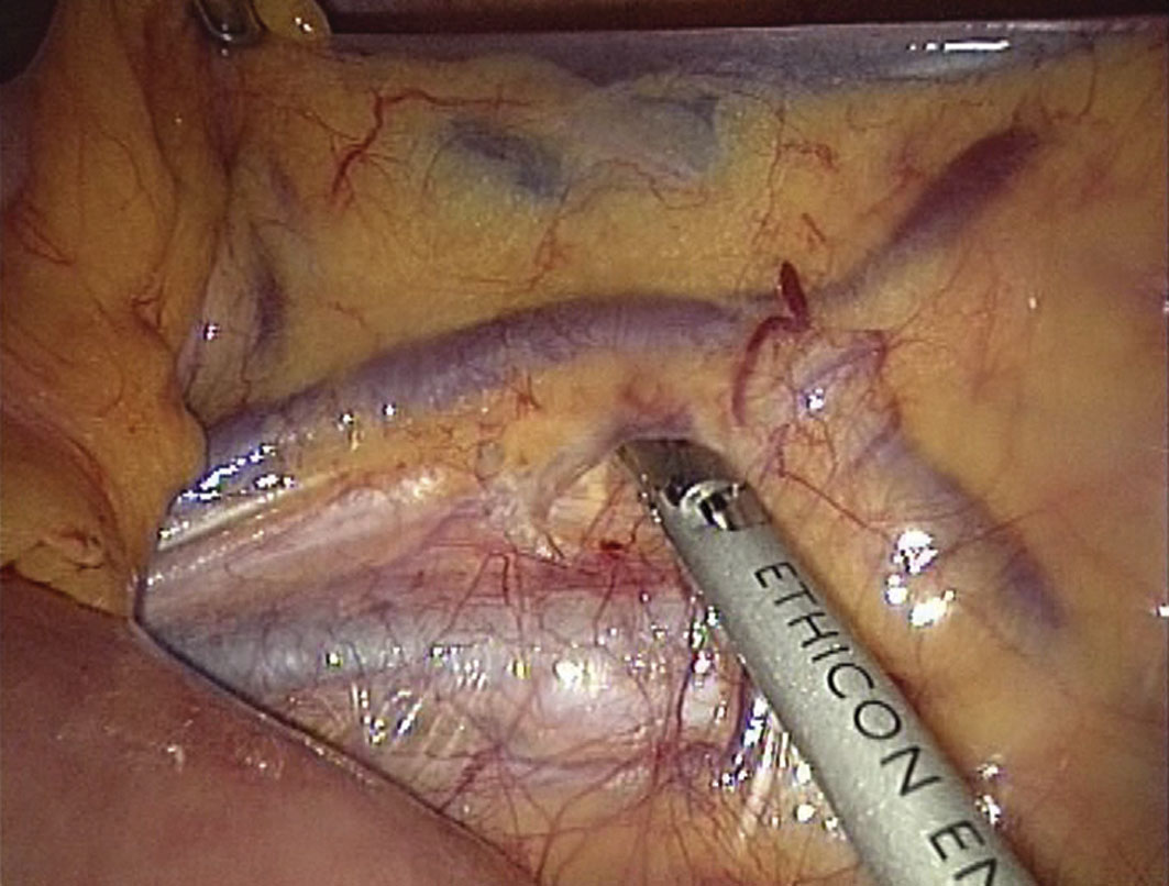 Intervento sul colon-retto chirurgia mini-invasiva (Laparoscopia)
