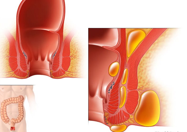 L'ascesso anale è una raccolta di pus prossimità ano-retto, conseguente ad infezione di ghiandola anale