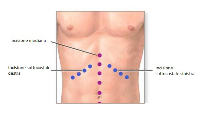 Gastrectomia totale o parziale intervento tradizionale OPEN