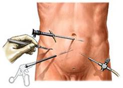 Gastrectomia totale o parziale laparoscopica mini-invasiva