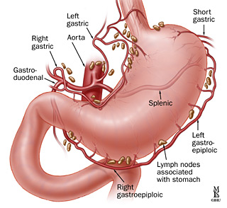 Intervento chirurgico rimozione adeno-carcinoma gastrico